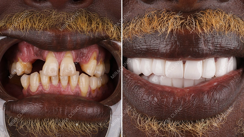 Before and After: Real Dental Implant Case